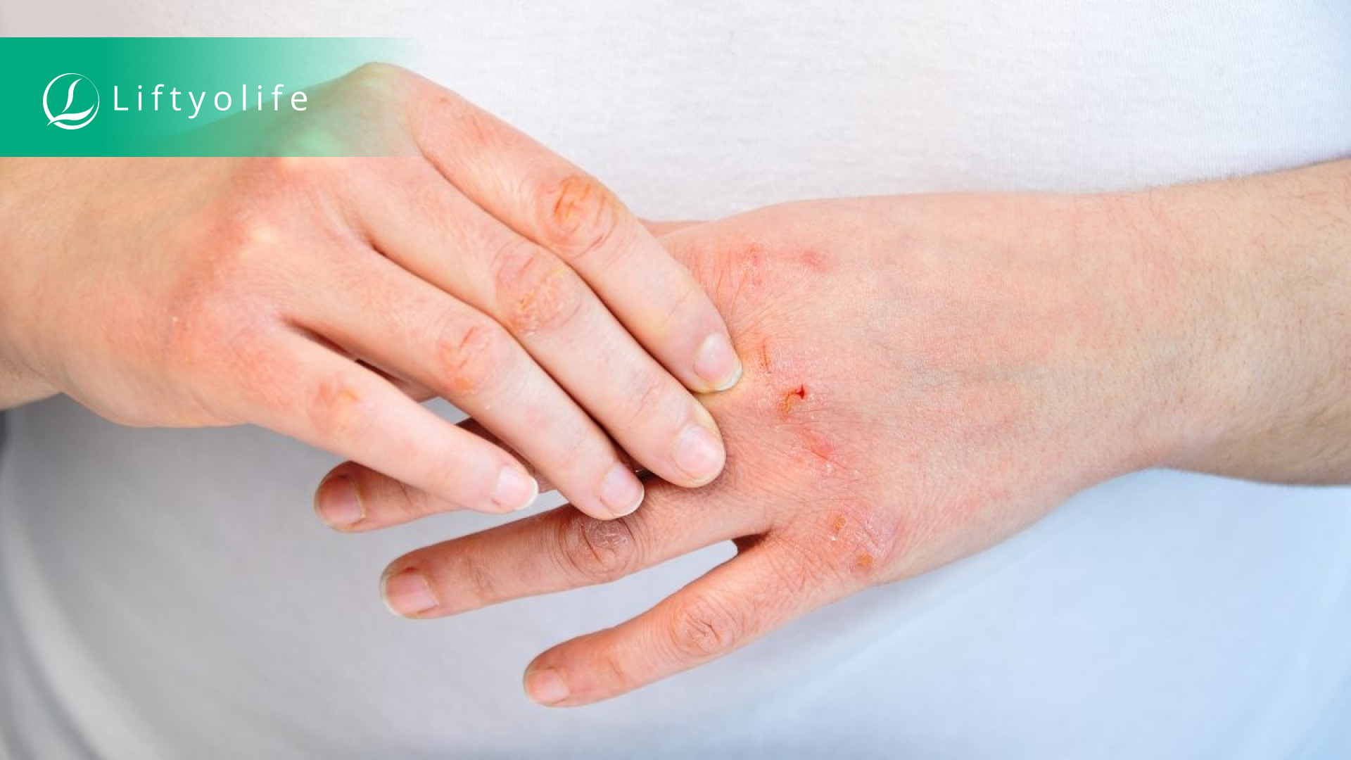 Atopic dermatitis (eczema)