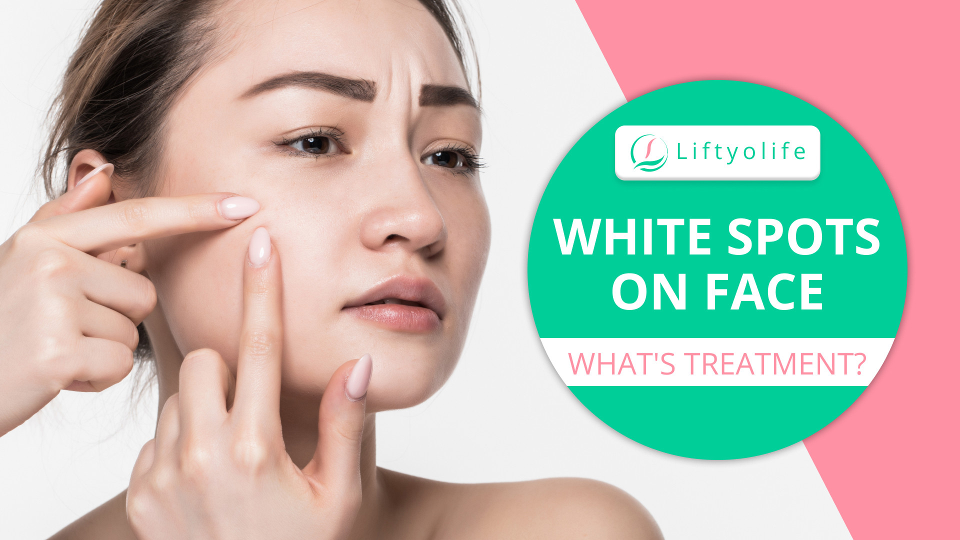 5 Causes Of White Spots On Face & Treatment