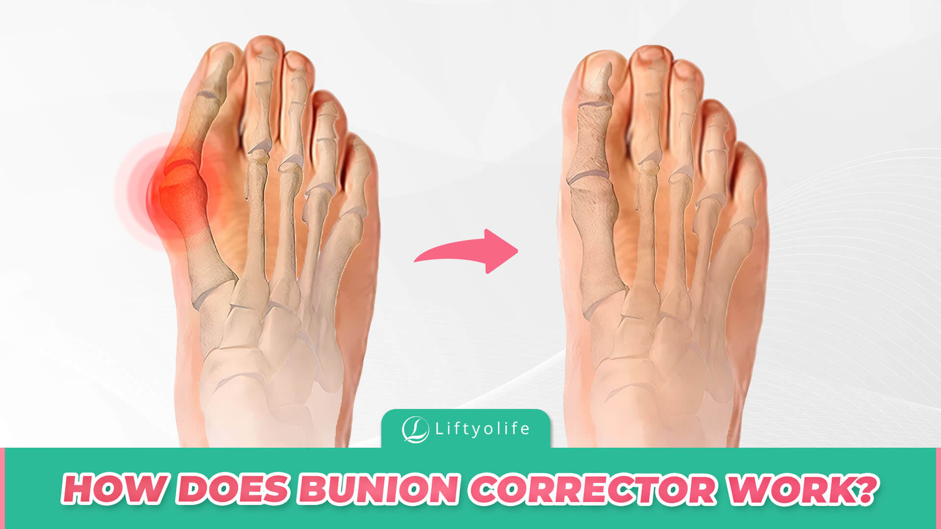 How Does Bunion Corrector Work?