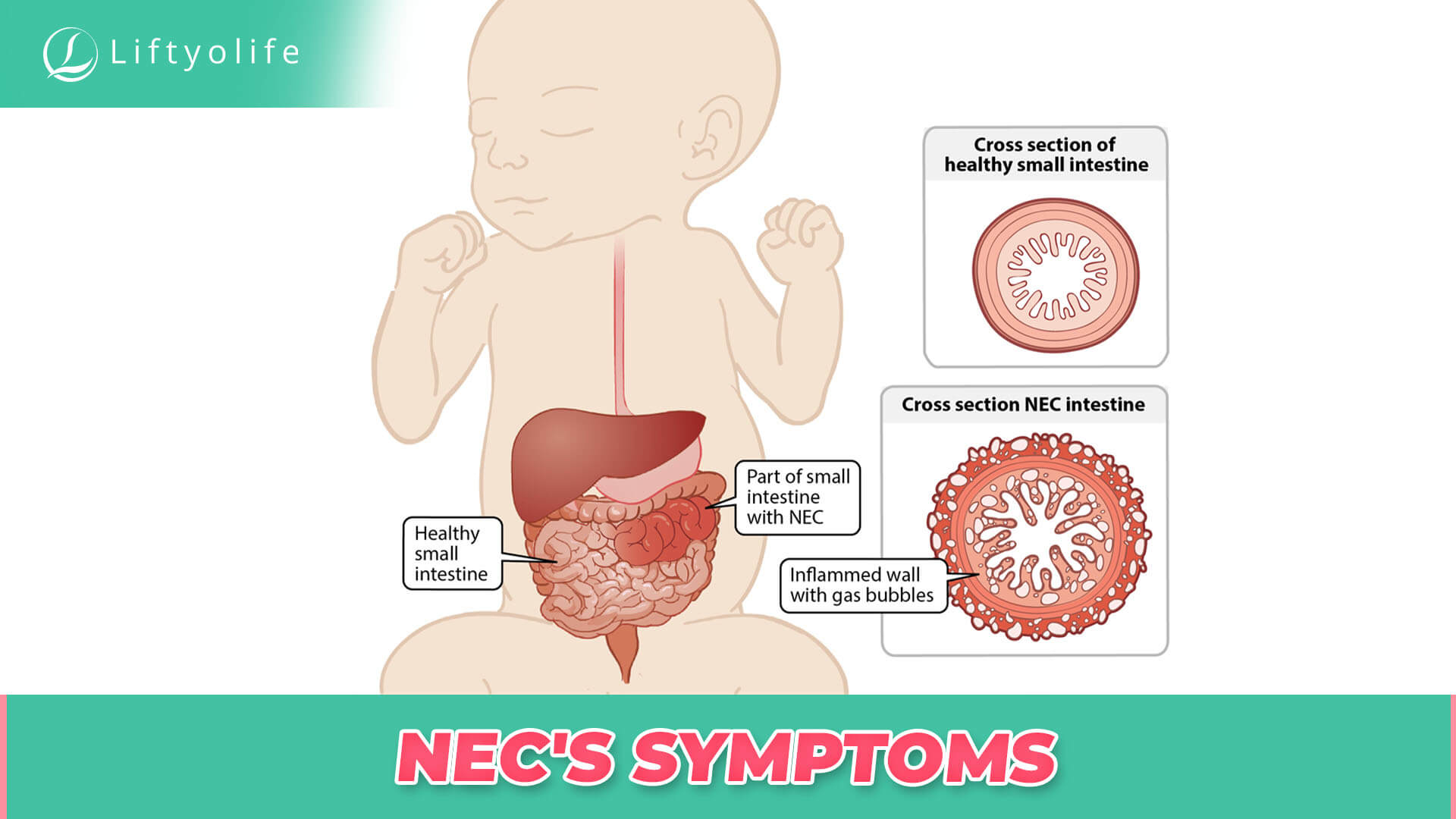 NEC's Symptoms
