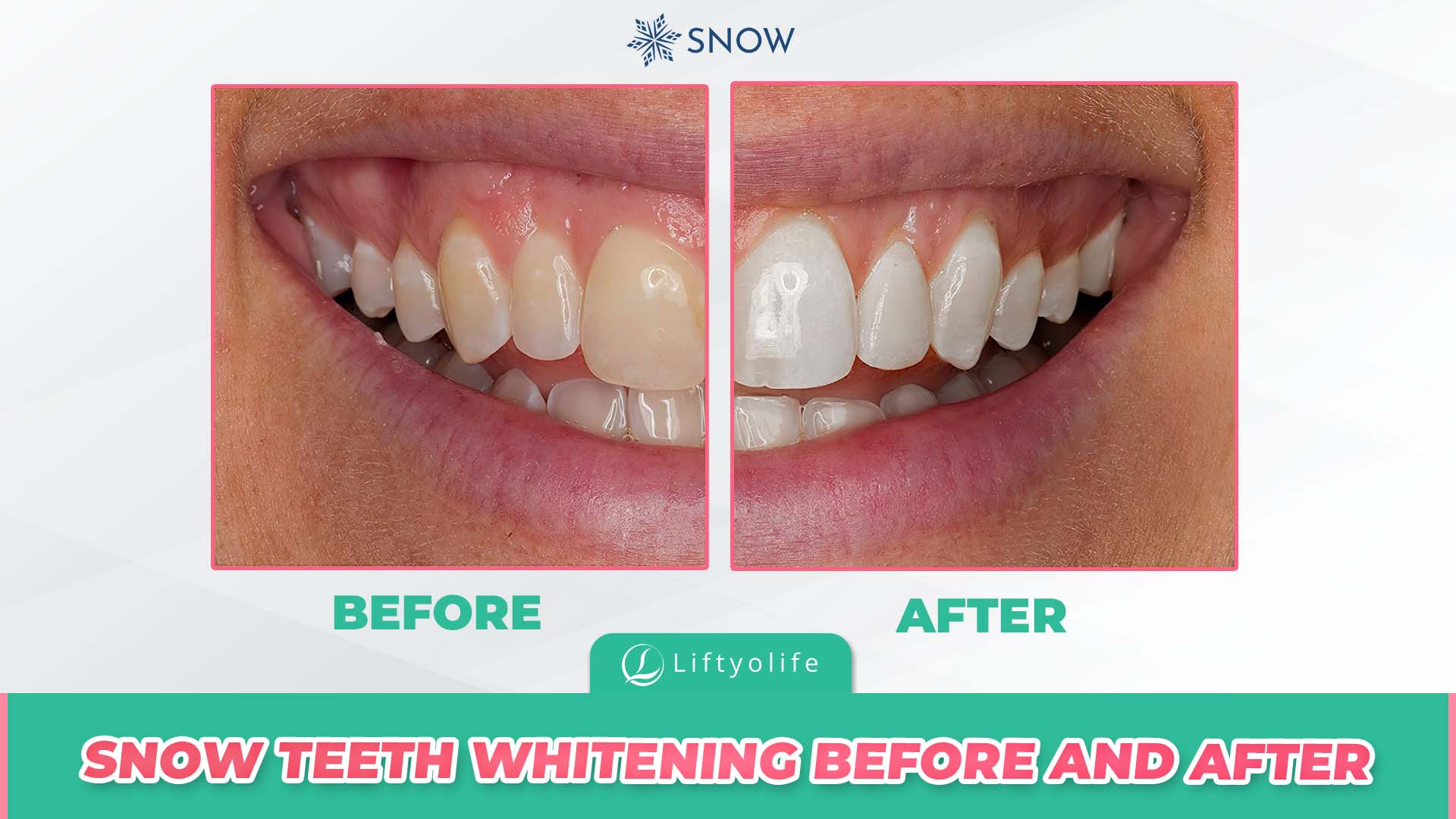 Snow Teeth Whitening Before And After