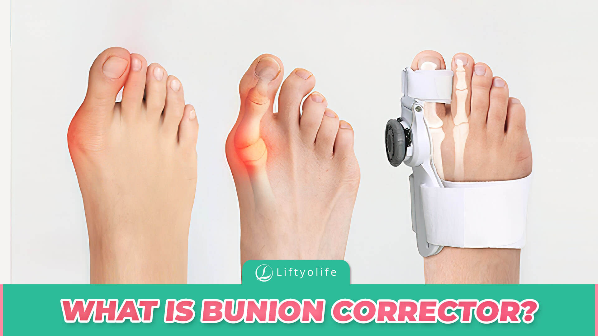 What Is Bunion Corrector?